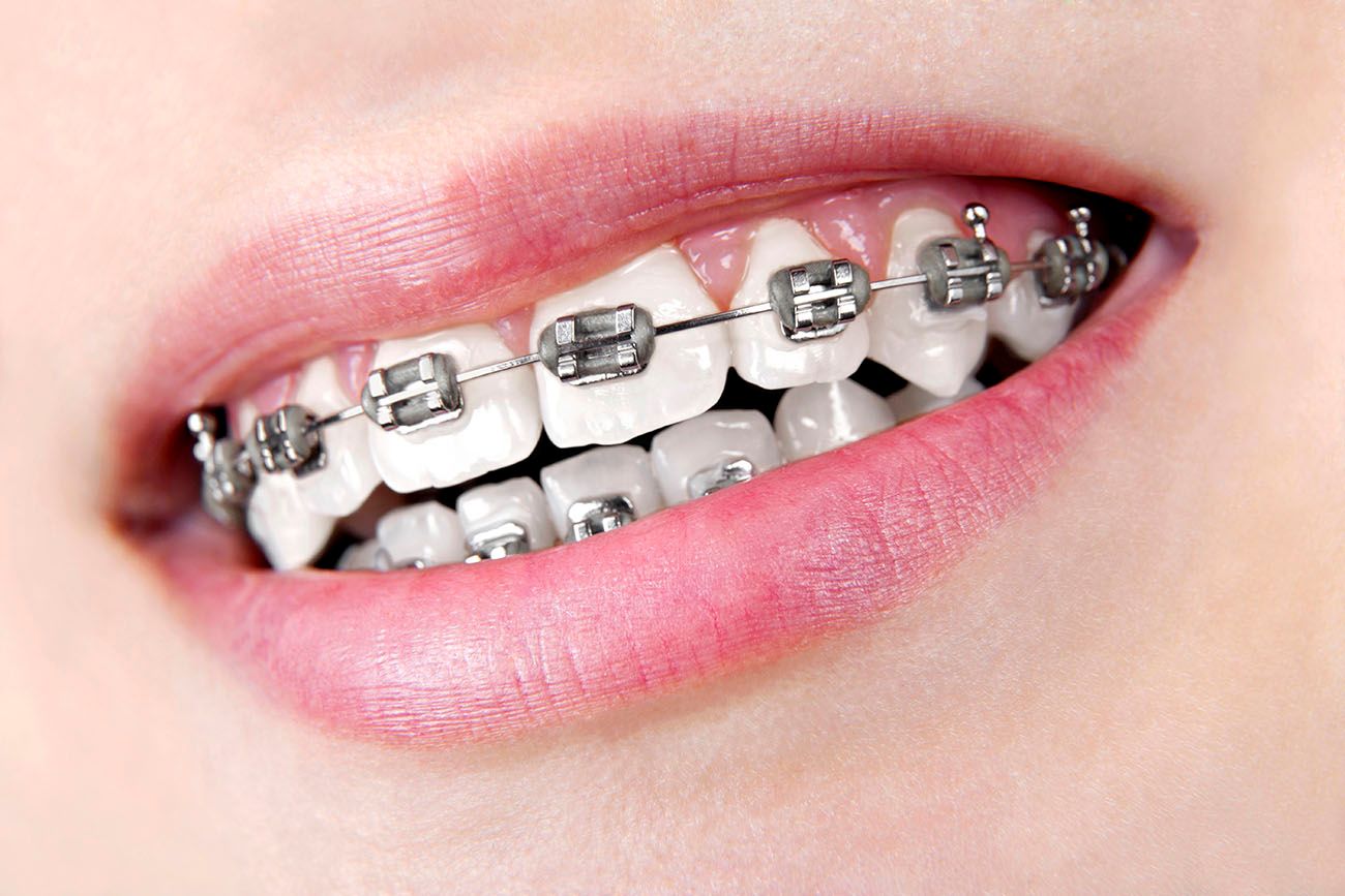 Why Should I Straighten My Smile? - Orthodontist in Irving, TX